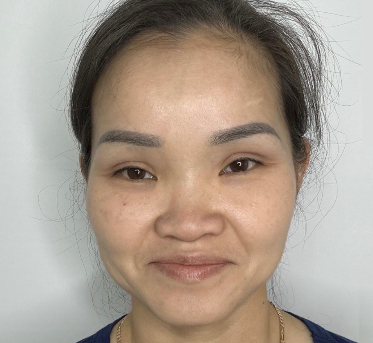 After Image: IPL and Personalized Skin Regimen - front