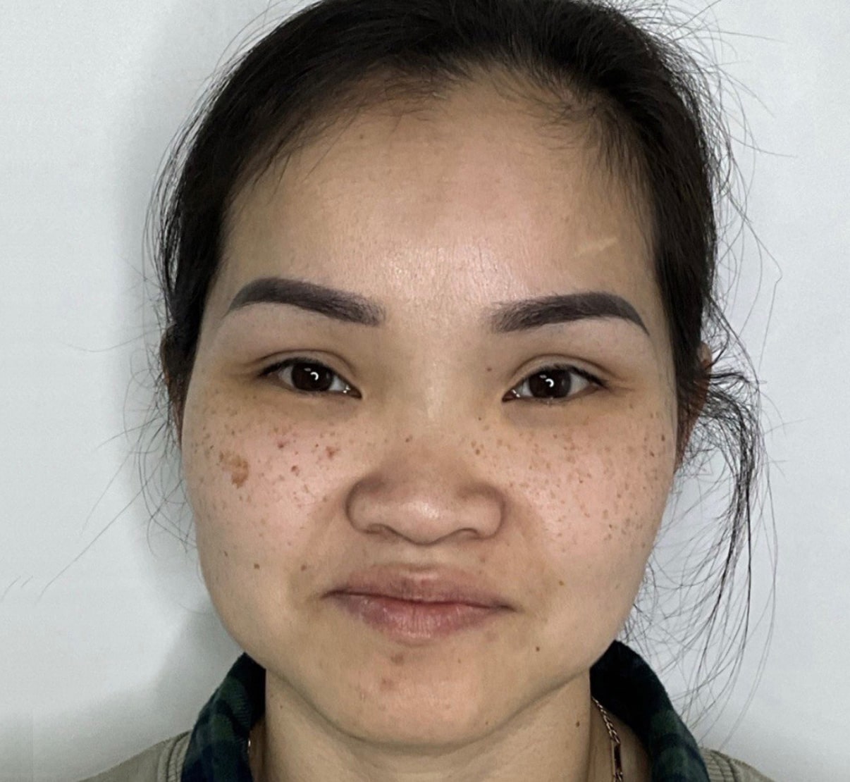 Before Image: IPL and Personalized Skin Regimen - front