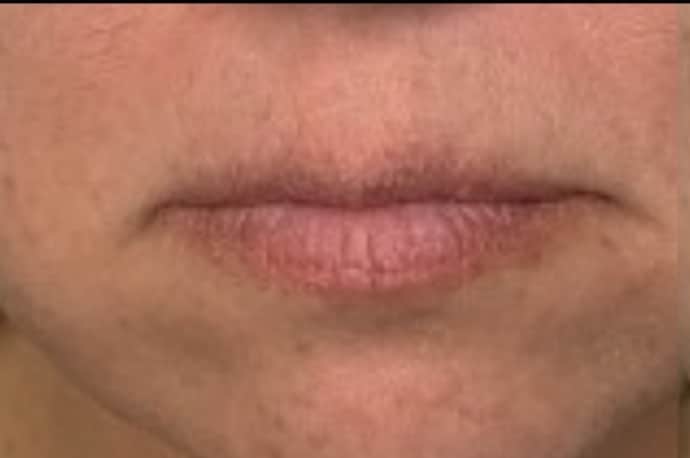 Before Image: Jenn – 0.5 syringe RHA2 - front