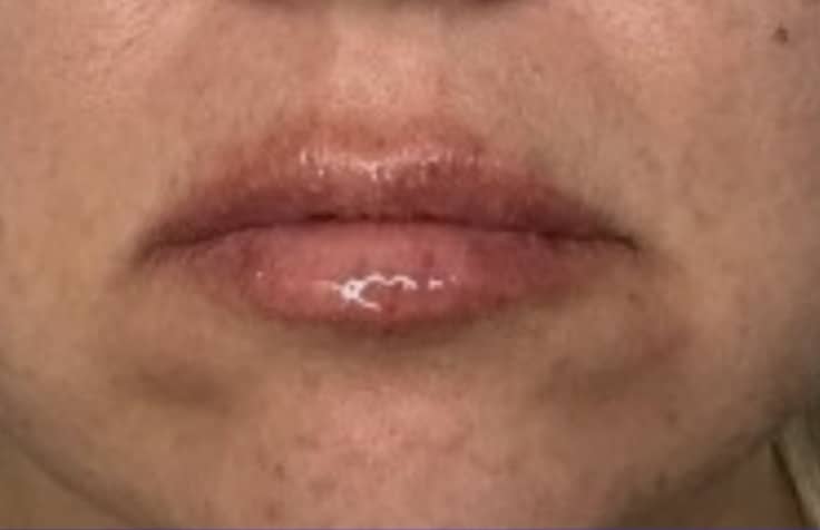 After Image: Jenn – 0.5 syringe RHA2 - front