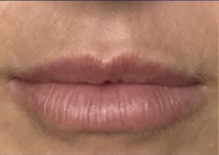 Before Image: Jenn – 0.5 syringe RHA3 - front