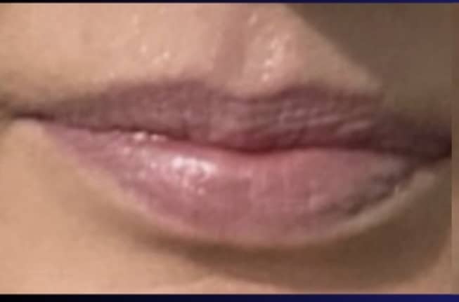 Before Image: Jenn – 0.5 syringe RHA3 - front
