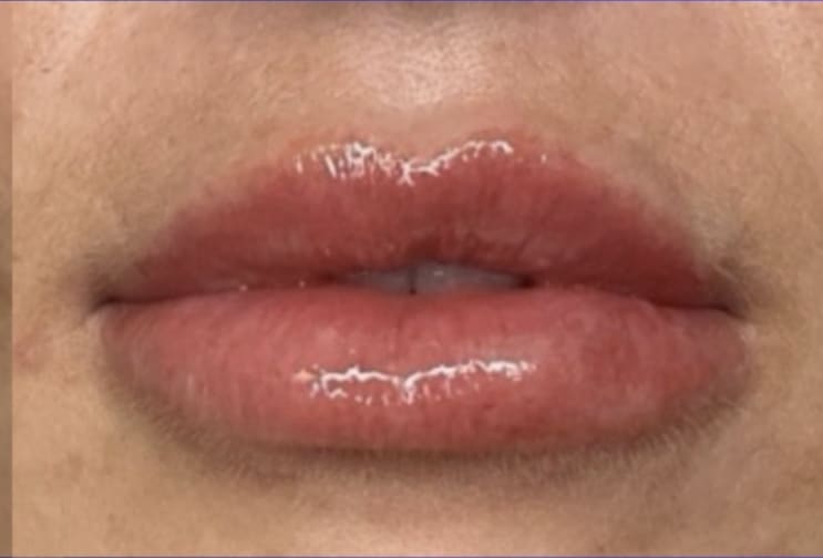 After Image: Jenn – 0.5 syringe RHA3 - front