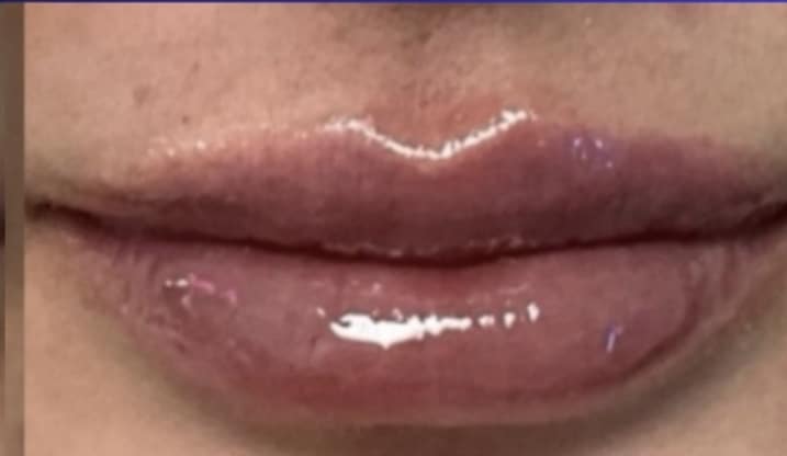 After Image: Jenn – 0.5 syringe RHA3 - front