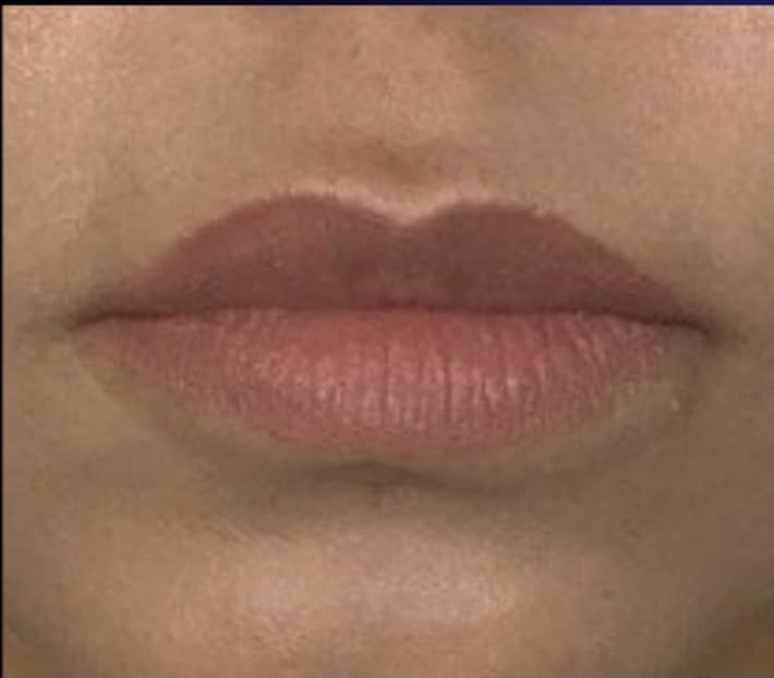 Before Image: Jenn – 1 syringe RHA3 - front