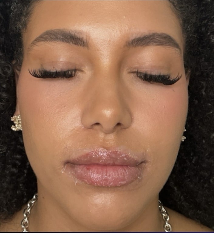 Before Image: Jenn – 1 syringe RHA3 - front
