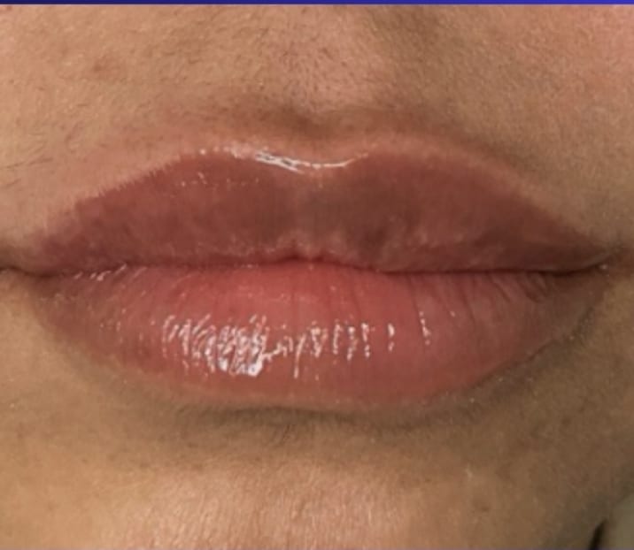 After Image: Jenn – 1 syringe RHA3 - front