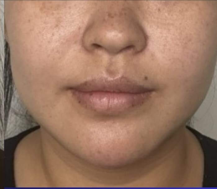 After Image: Jenn – 1 syringe Radiesse in jawline - front
