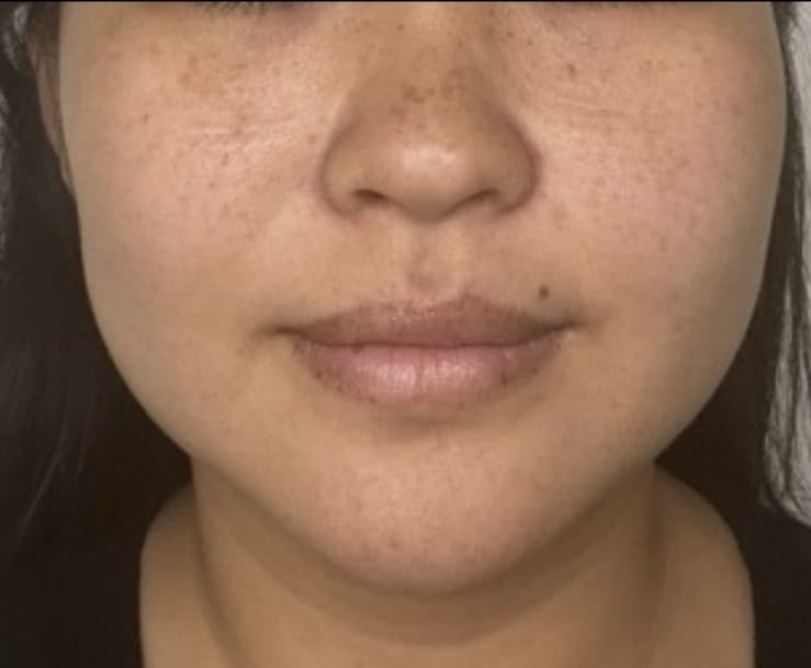 Before Image: Jenn – 1 syringe Radiesse in jawline - front