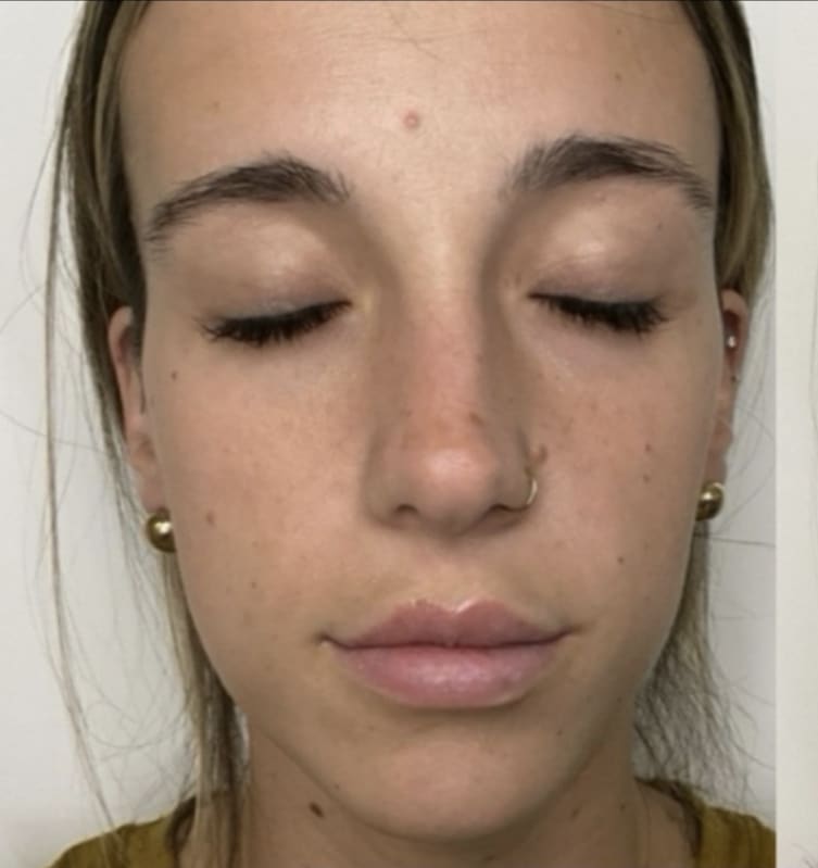 Before Image: Jenn – 1 syringe Restylane Kysse - front