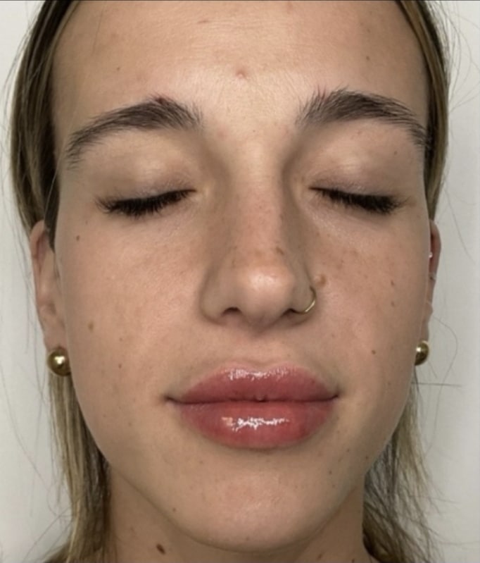 After Image: Jenn – 1 syringe Restylane Kysse - front