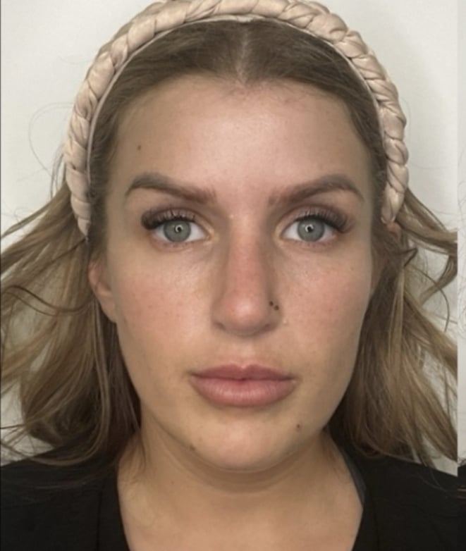Before Image: Jenn – 1 vial Sculptra , multi point injections - front