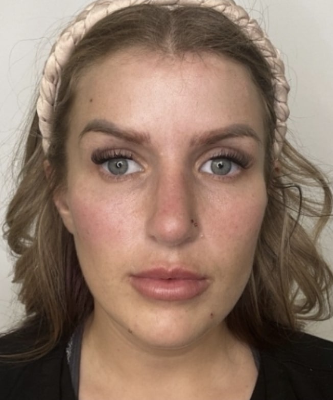 After Image: Jenn – 1 vial Sculptra , multi point injections - front