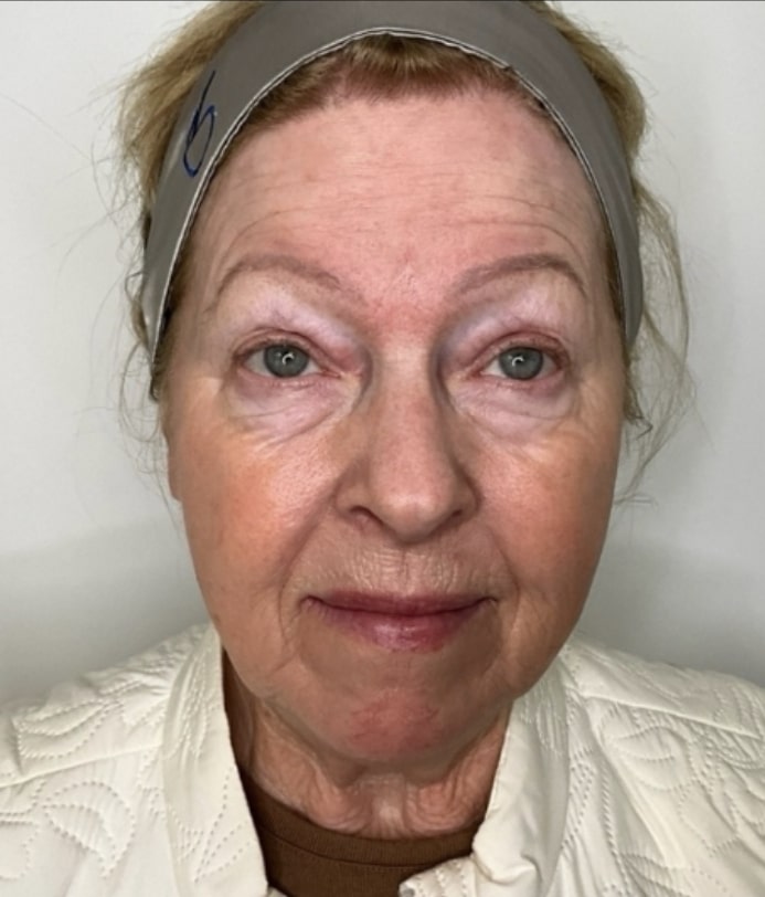 Before Image: Jenn – ZO Anti-aging skincare protocol and Neurotoxins - front