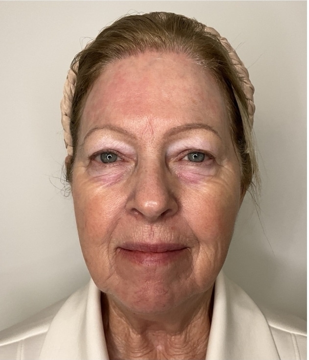 After Image: Jenn – ZO Anti-aging skincare protocol and Neurotoxins - front