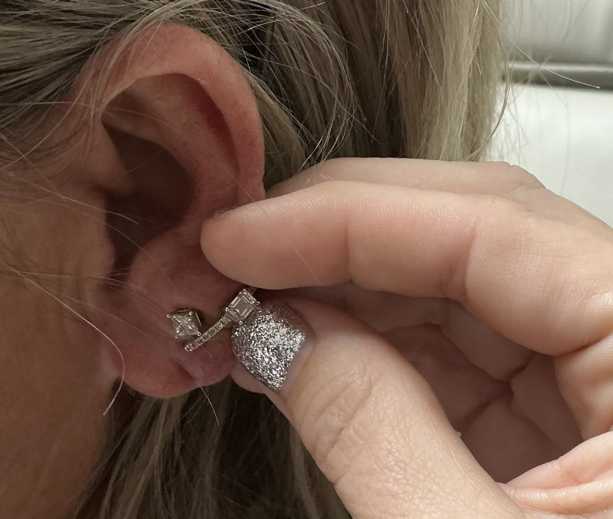 After Image: Ear Lobe Filler - front