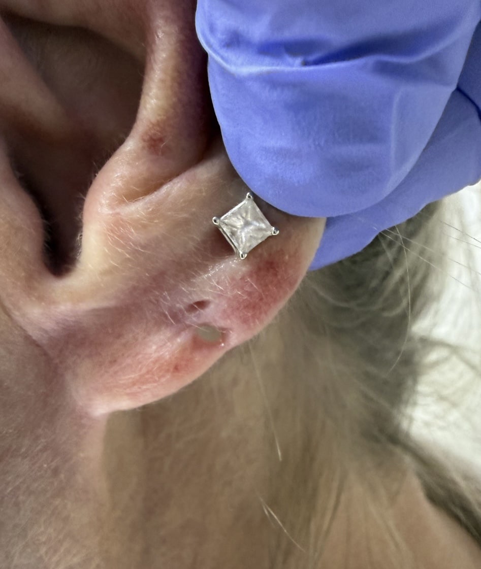 Before Image: Ear Lobe Filler - front