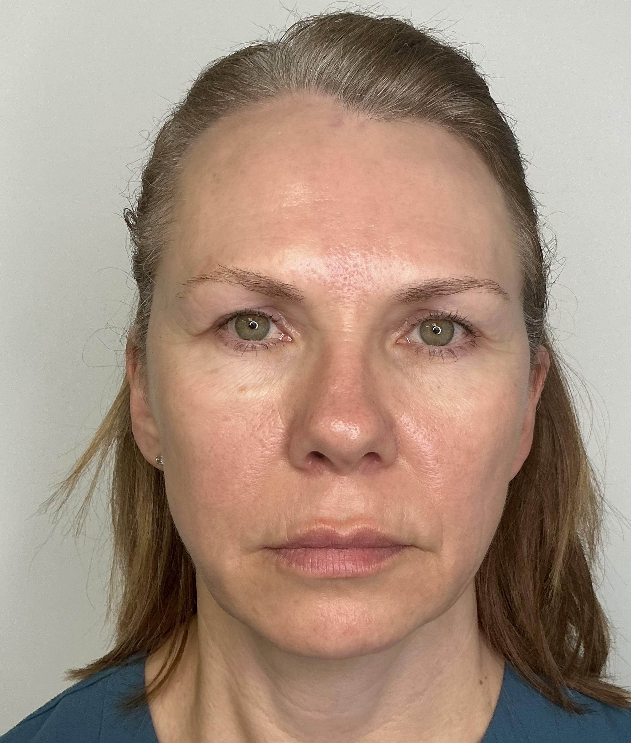 After Image: Tox / Facial Balancing / Radiesse - other