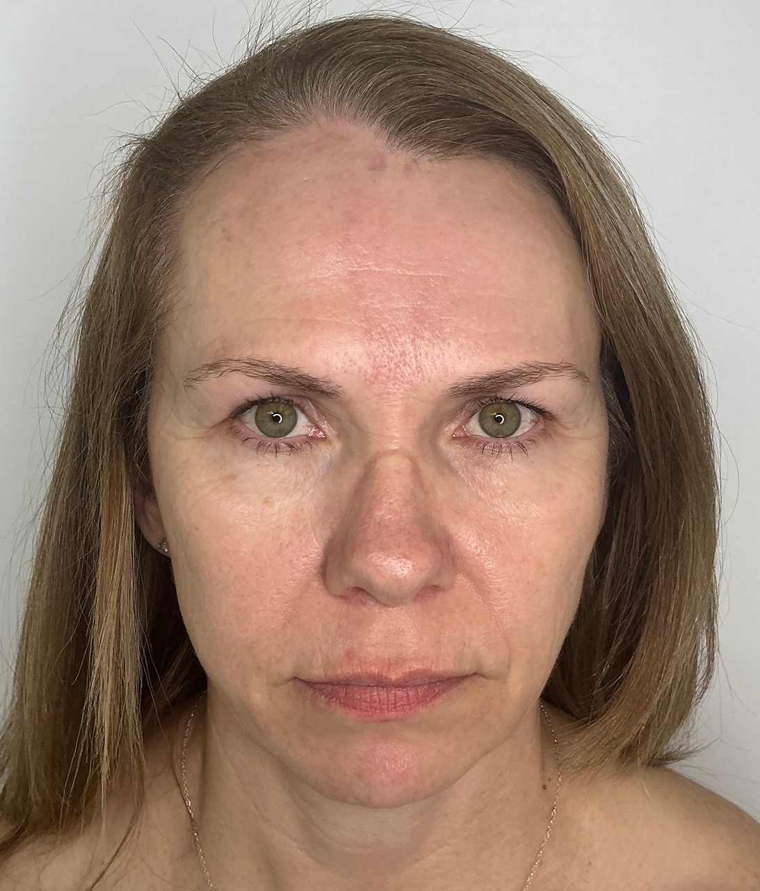 Before Image: Tox / Facial Balancing / Radiesse - other