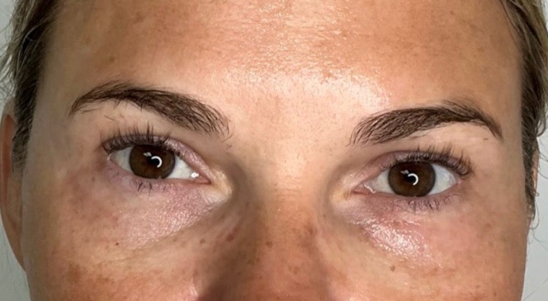 Before Image: PDGF - other