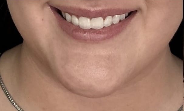 Before Image: Restylane Kysse - front