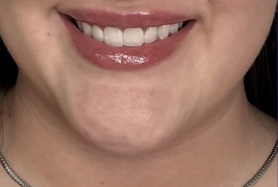 After Image: Restylane Kysse - front