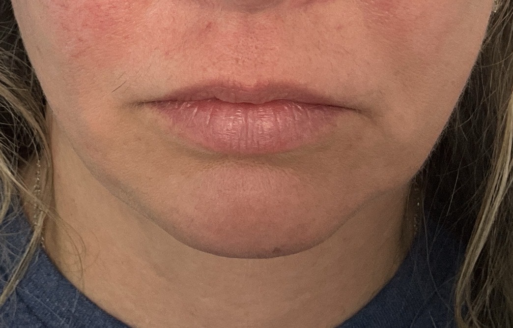 Before Image: 1/2 Syringe of RHA 2 in Upper Lip - front