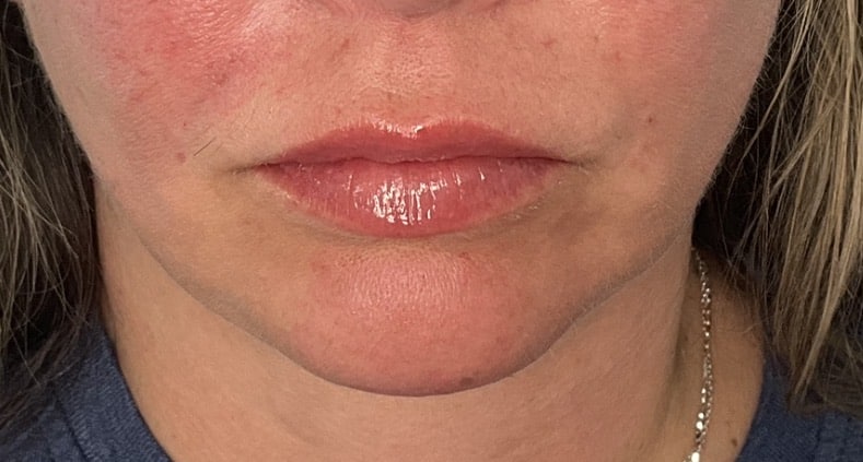 After Image: 1/2 Syringe of RHA 2 in Upper Lip - front